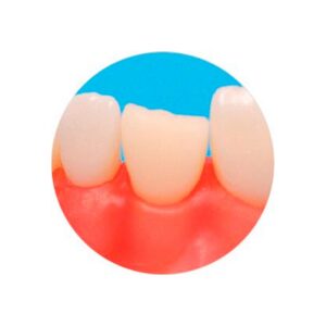Dente 21.6 Dente Fraturado 2210 - Prodens