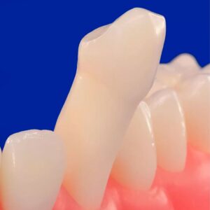 Dentes para Preparo De Lentes - Prodens